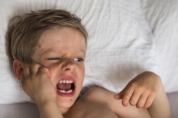 Norice: Cepljeni otroci niso zboleli