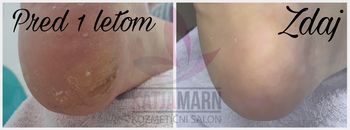 Odstranjevanje zadebeljene kože 