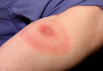 Subvencionirano cepljenje proti klopnemu meningoencefalitisu