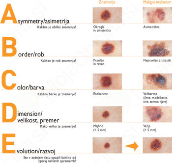 Kožni rak ni samo črna lisa – najpogosteje je trdovratna rana Kožni rak ni samo črna lisa – najpogosteje je trdovratna rana